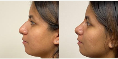 18-24 year old woman treated with Rhinoplasty - One month after a rhinoplasty