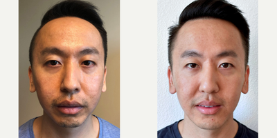25-34 year old man treated with Jaw Surgery - 25-34 year old man treated with Jaw Surgery