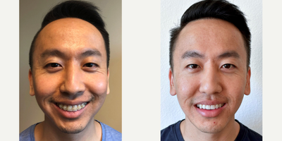 25-34 year old man treated with Jaw Surgery - 25-34 year old man treated with Jaw Surgery