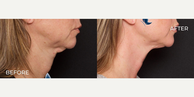 Woman treated with Thread Lift - Woman treated with Thread Lift