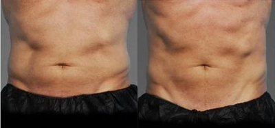 Patient treated with CoolTone - Magnetic Muscle Stimulation - an electromagnetic field generated by the CoolTone device that induces a current of sufficient amplitude and duration to ultimately stimulate muscle contraction! The result is toned muscles! 