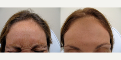 Woman treated with Dysport - Woman treated with Dysport.