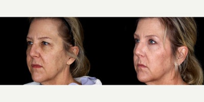 54 year old woman treated with Eyelid Surgery, Cheek Lift - 54 year old woman treated with Eyelid Surgery, Cheek Lift. Photos depict before and 6 months after surgery.