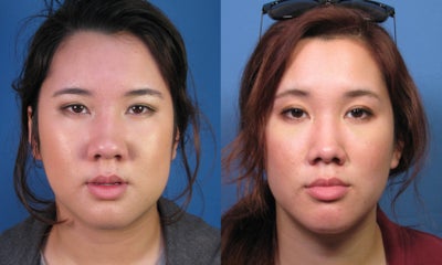 Asian Rhinoplasty Surgery Ethnic Rhinoplasty Example - 
	This is a good example of Asian rhinoplasty, or Asian nose job, surgery. This patient had her nasal bones narrowed to create a more refined bridge appearance. In addition, her rounded, bulbous nasal tip was narrowed and lengthened while the base was brought in on both sides. Overall, you can tell she has a more refined looking nose yet she still looks ethnic and natural.
