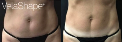 45-54 year old woman treated with Velashape - 3 sessions Velashape