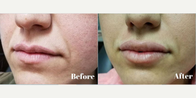 25-34 year old woman treated with Juvederm - The patient had 1cc of Juvederm Ultra in the upper and lower lip for beautiful and natural results.