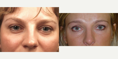 35-44 year old woman treated with Eyelid Surgery - lower blepharoplasty