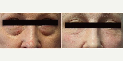 55-64 year old woman treated with Juvederm, Volbella, Voluma, Restylane, Restylane Contour - 4D Under Eye Lift - Treatment of dark circles & bags under eyes and cheek restoration with Belotero, Restylane, Volbella and Voluma