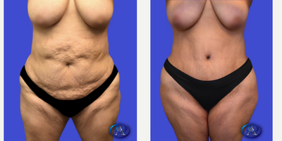 45-54 year old woman treated with Tummy Tuck, Umbilical Hernia Repair - 51-year-old patient 6 months post abdominoplasty + hernia repair