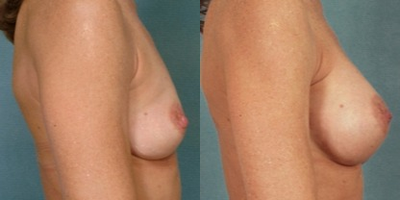 45-54 year old woman treated with Breast Augmentation - Age: 46
Height: 5'6
Weight: 120 lbs.
Implant Type: Natrelle Silicone Moderate Plus Profile
Implant Size: 286 cc
This woman felt deflated after children. She wanted to feel more comfortable in her clothes. Dr. Bucky utilized style 15 286cc moderate profile silicone gel breast implants in a submuscular position.