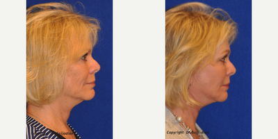 Chin Liposuction - Chin Liposuction