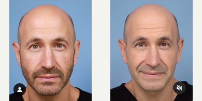 Man treated with BroadBand Light - Man treated with BroadBand Light