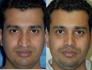 Rhinoplasty - A heavy bump and droopy tip are corrected with rhinoplasty