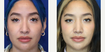 Woman treated with Rhinoplasty - Rhinoplasty