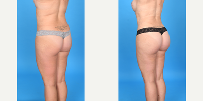35-44 year old woman treated with Body Lift, Brazilian Butt Lift, Brazilian Butt Lift Revision, Butt Augmentation, Butt Lift, La - Before and after skinny BBL as part of a mommy makeover: Breast augmentation, tummy tuck, and BBL. We added 500cc pure fat to each butt to give a better shape and size. I call this a skinny BBL as the goal is always a perfect shape and not necessarily maximum volume.