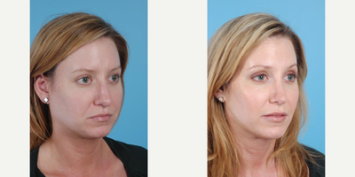33 year old woman treated with Rhinoplasty - A 33 year old woman before and after Rhinoplasty with Andrew T. Lyos M.D FACS.