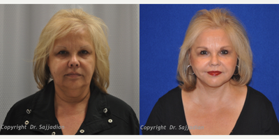 Chin Liposuction - Chin Liposuction
