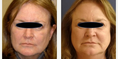 Woman treated with Excel V, Laser Genesis - Woman treated with Excel V, Laser Genesis