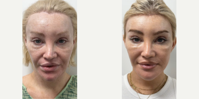 40 year old woman treated with Jaw Reduction - 40 year old woman treated with revision Forehead Reduction (hairline advancement), mid Facelift Revision, revision Jaw Reduction, Genioplasty, and Facial Fat Transfer to the tear troughs and midface. Pre-op, patient had a botched hairline advancement and other facial procedures by another surgeon in 2022. Patient is shown before and 5 weeks post-op.