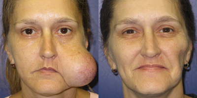 46-year old woman treated with Lipoma Removal - This patient's facial mass has enlarged over a period of 16 years. She underwent removal of this mass along with contouring of the facial skin.