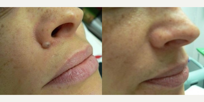 Woman treated with Mole Removal - Woman treated with Mole Removal