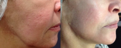 65-74 year old woman treated with Skin Rejuvenation - Picosure skin rejuvenation after 6 treatments.