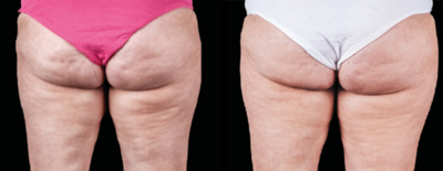 45-54 year old woman treated with Emtone - EMTONE treatments after 4X in 2 weeks and 12 week final results.
