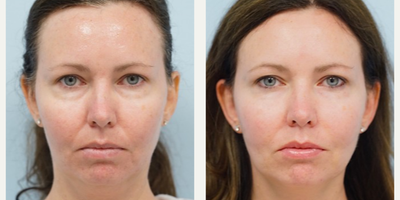 35-44 year old woman treated with Radiesse - Radiesse to nasolabial folds is injected using the cannula. Post one week result shows very natural correction to one of the most sought after volumizing areas on the face.