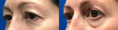 45-54 year old woman treated with Eyelid Surgery - This woman underwent upper blepharoplasty surgery to lift her eyelids.