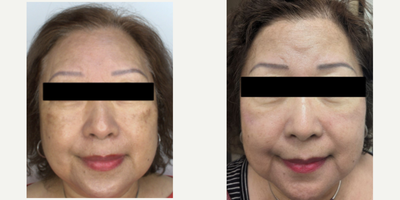 55-64 year old woman treated with BroadBand Light (BBL), Moxi - BBL and Moxi Treatment after one session completed.