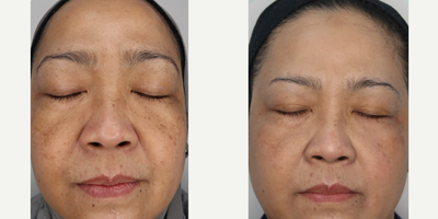 55-64 year old woman treated with BroadBand Light (BBL), Moxi - Three treatments of BBL and Moxi