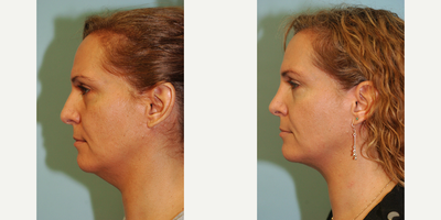 35-44 year old woman treated with Rhinoplasty - Rhinoplasty