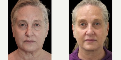 65-74 year old woman treated with MyEllevate, Nonsurgical Neck Lift - 67 year old female 3 weeks following the MyEllevate Plus procedure with placement of a permanent suture to enhance structural neck definition through a series of tiny punctures immediately below the lower edge of the jawline and excision of skin behind the ear.