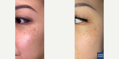 Woman treated with IPL - After 1 session of IPL to lighten the hyperpigmentation aka sun damage