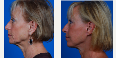 45-54 year old woman treated with SMAS Facelift - concerned about cheeks, neck and facial aging. SMAS lift with facial fat grafting