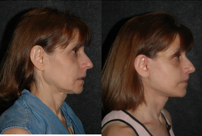 Lip Repositioning - Lip Lift + Deep Plane Facelift
