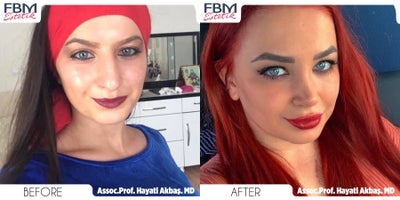 18-24 year old woman treated with Rhinoplasty - 18-24 year old woman treated with Rhinoplasty