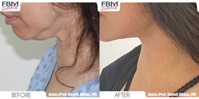35-44 year old woman treated with Mini Neck Lift - 35-44 year old woman treated with Mini Neck Lift