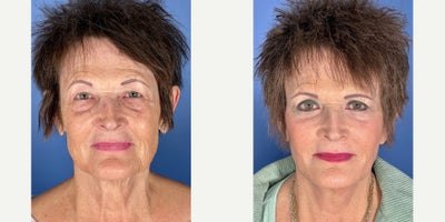 65-74 year old woman treated with Facelift, Eyelid Surgery - Patient underwent a Face and Neck Lift with Upper and Lower Eyelids Procedure. Post-Op photo taken at 6 weeks.