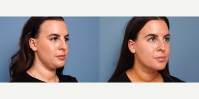 29 year old woman treated with myellevate - 29 year old woman treated with myellevate . Photos depict before and 1 week after surgery