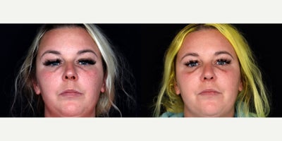 35 year old woman treated with Septoplasty, Rhinoplasty - 35 year old woman treated with Septoplasty, Rhinoplasty. Photos depict before and 2 months after surgery