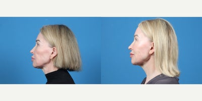 55-64 year old woman treated with Facelift, Neck Lift - MINI FACELIFT. NECKLIFT.SCAR REVISION