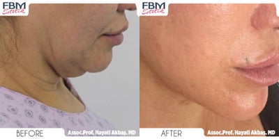 45-54 year old woman treated with Deep Plane Facelift, Neck Lift, Rhinoplasty, Lip Lift, Canthoplasty, Eyelid Surgery, Facial Fa - 45-54 year old woman treated with Deep Plane Facelift, Neck Lift, Rhinoplasty, Lip Lift, Canthoplasty, Eyelid Surgery, Facial Fat Transfer