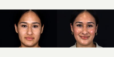 25 year old woman treated with Septoplasty, Rhinoplasty, Dermabrasion - 25 year old woman treated with Septoplasty, Rhinoplasty, Dermabrasion. Photos depict before and 2 months after surgery