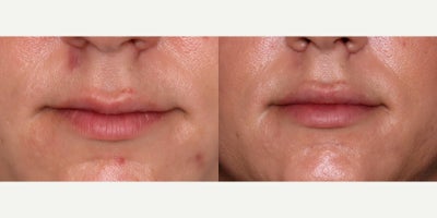 33 year old woman treated with Lip Fillers (Restylane Kysse) - 33 year old woman treated with Lip Fillers (Restylane Kysse) Photos depict before and 1 month after 1 syringe to lips.