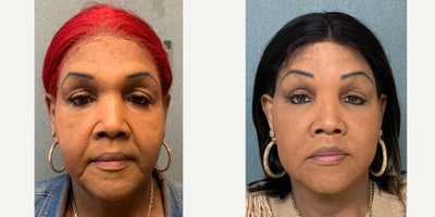 55-64 year old woman treated with Brow Lift, Forehead Reduction, Facial Feminization Surgery, Lip Lift, Lip Surgery - This is a lady who underwent forehead feminization surgery and lip lift.