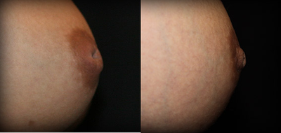Nipple Surgery - 	Nipple Surgery