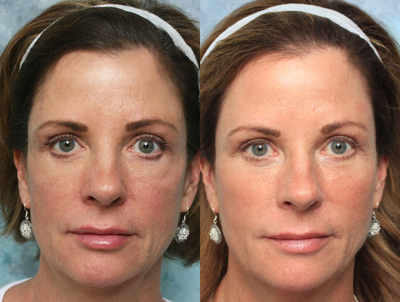 55-64 year old woman treated with Eyelid Retraction Repair - 57 year old woman with unsatisfactory quadrilateral blepharoplasty.Diagosis:1. S/P Quadralateral blepharoplasty2. S/P Facial fat grafting3. S/P Hyaluronic acid filler to the upper eyelids4. Post Upper Blepharoplasty Syndrome5. Vertical and horizontal inadequacy of the lower eyelidsTreatment: Staged bilateral lower eyelid reconstruction with hard palate graft, ePTFE orbital rim implant and vertical midface lift.