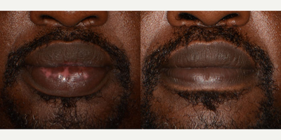 Lip Reduction - Surgical Lip reduction of upper and lower lips