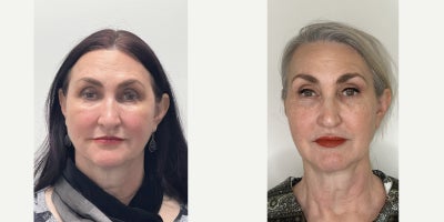 55-64 year old woman treated with Fractional Laser, Microneedling RF, Agnes RF - Along with more than 20 pounds weight loss over 3 years, Used our signature Triple Glow Lift ,to improve skin lines, sunken eyes, prevent sagging and over all rejuvenate the skin quality